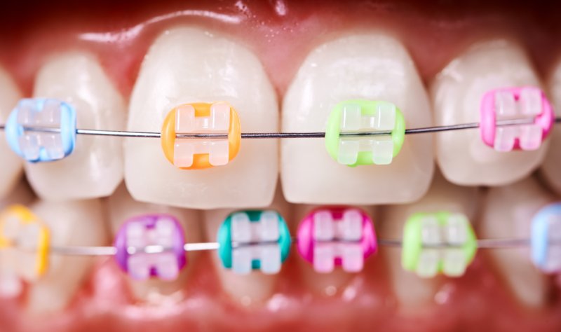 Closeup of colorful rubber bands for braces