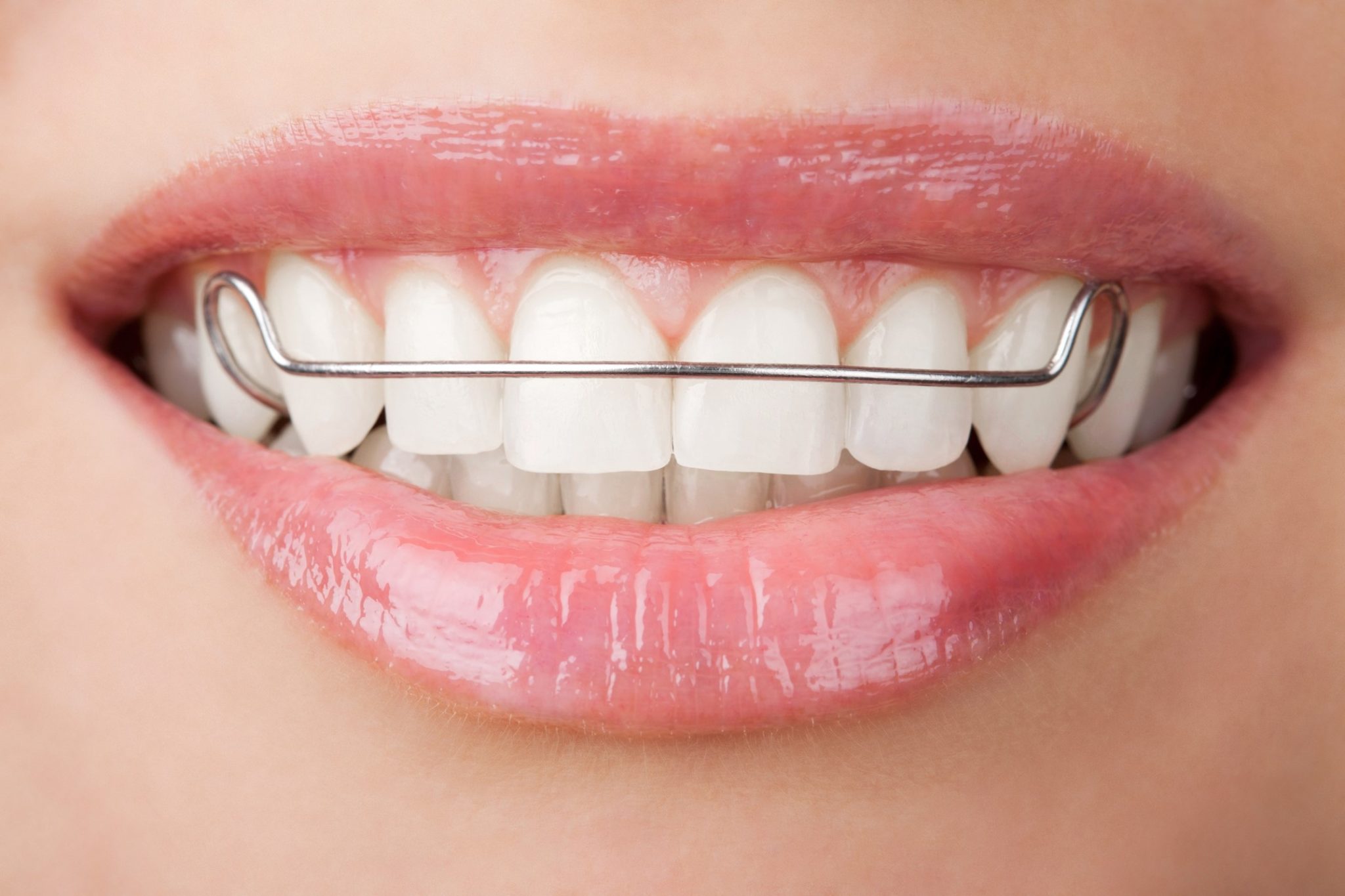 How Often Should I Replace My Retainer? Simply Orthodontics