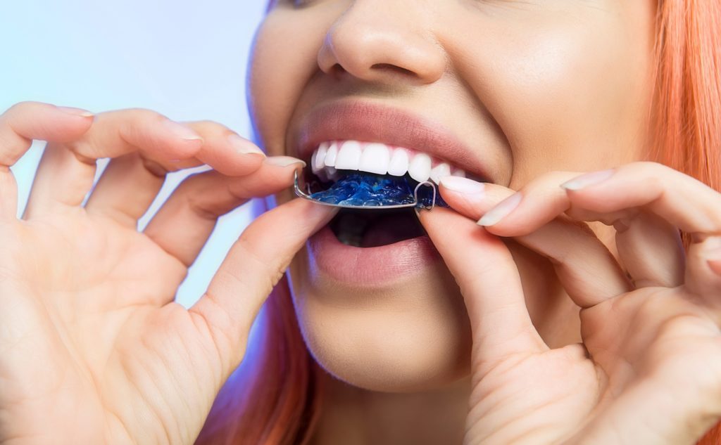 Closeup of woman putting on her blue retainer