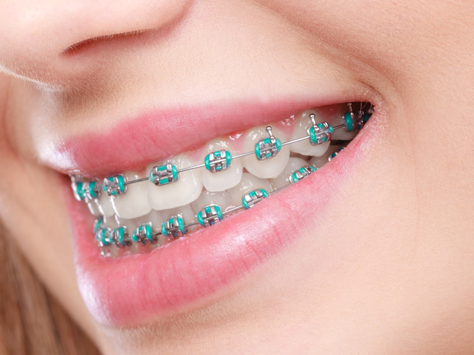 Braces Survival Kit Simply Orthodontics Worcester
