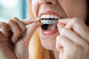 a patient wearing their Invisalign aligner